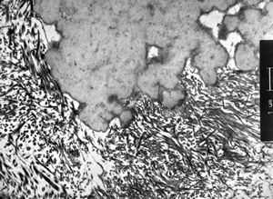 F,74y. | ossifying fibromyxoid tumor - submandibular gland F,74y. | ossifying fibromyxoid tumor - submandibular gland